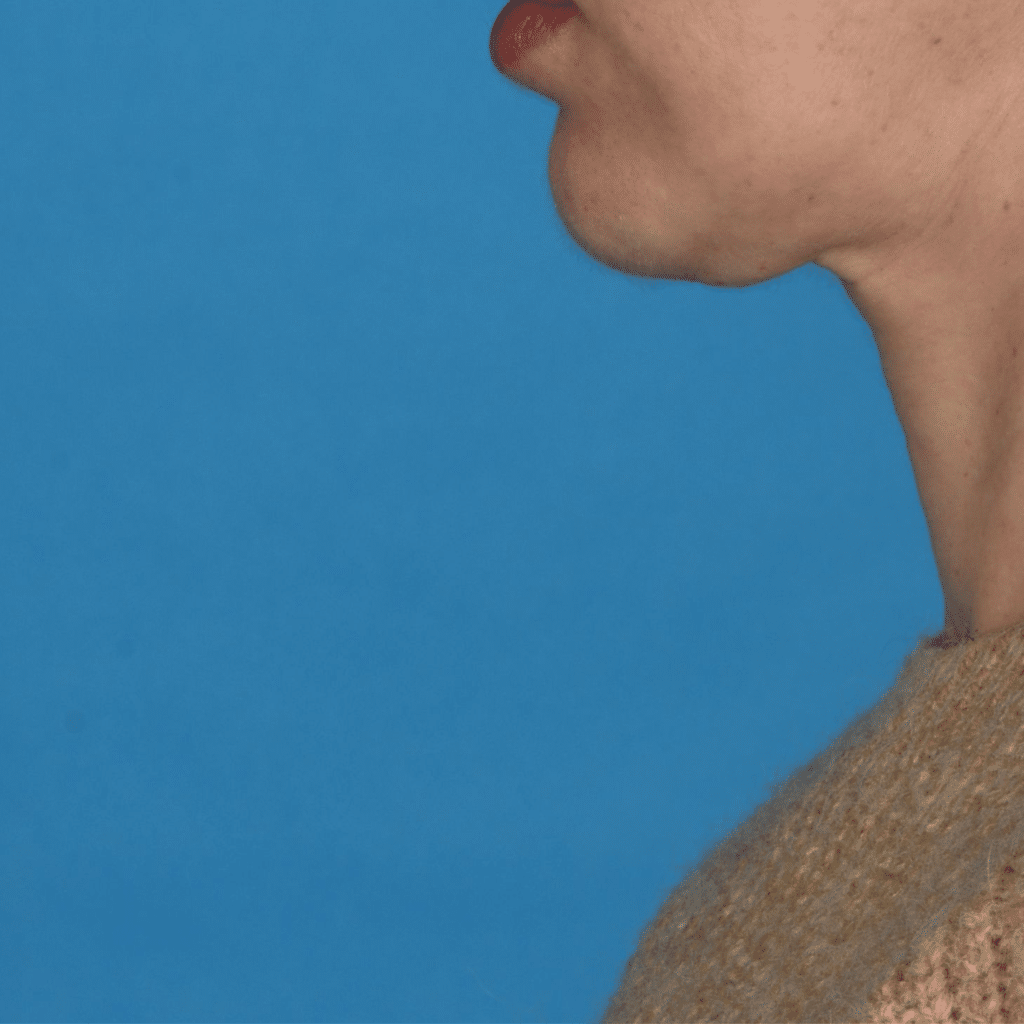 Before Image: Facelift/necklift - left-side