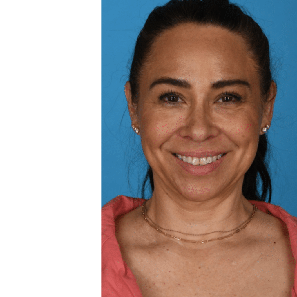 Before Image: Facelift, necklift, upper blepharoplasty - front