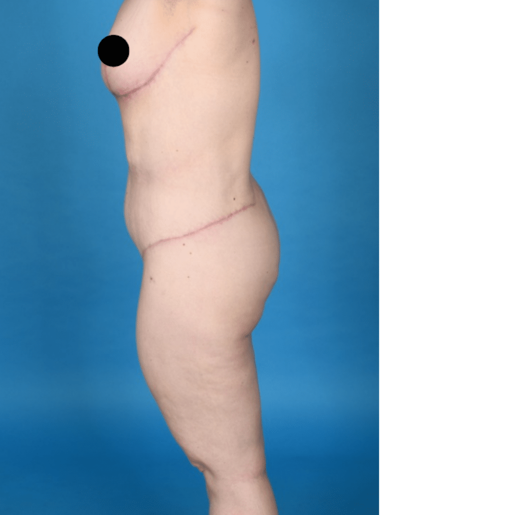 After Image: Extended abdominoplasty, breast lift (mastopexy) - left-side