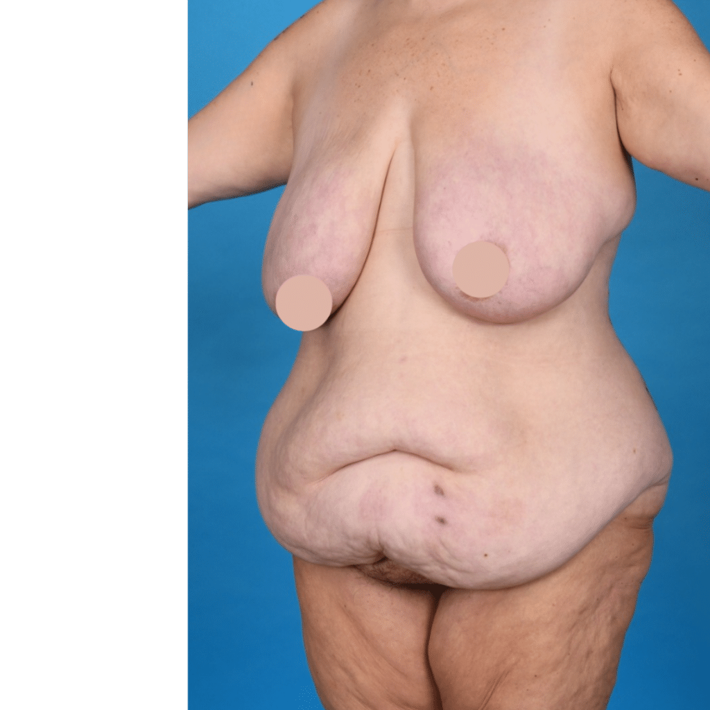 Before Image: Circumferential abdominoplasty, bilateral breast reduction, liposuction 360 - back
