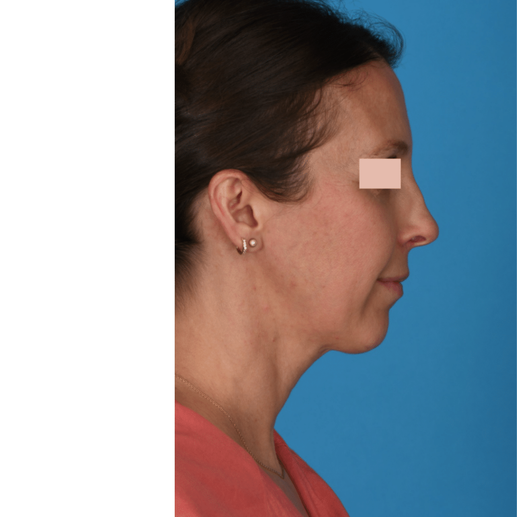 Before Image: Revision Rhinoplasty - right-side