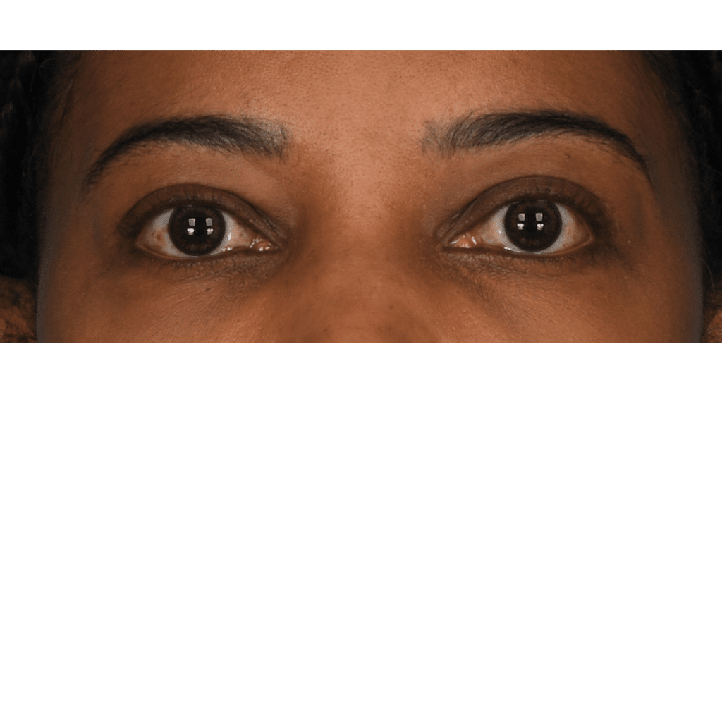 After Image: Upper blepharoplasty - front