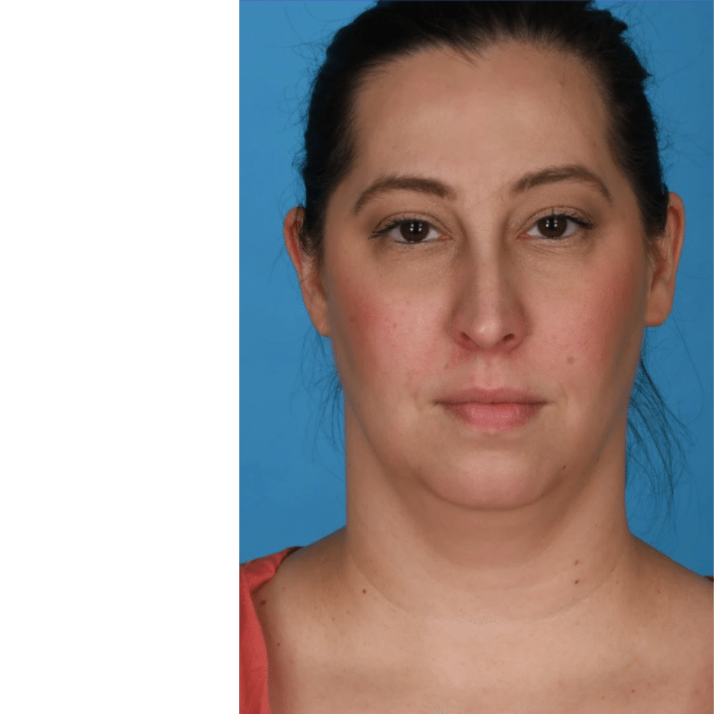 Before Image: Submental (under chin) Liposuction - front