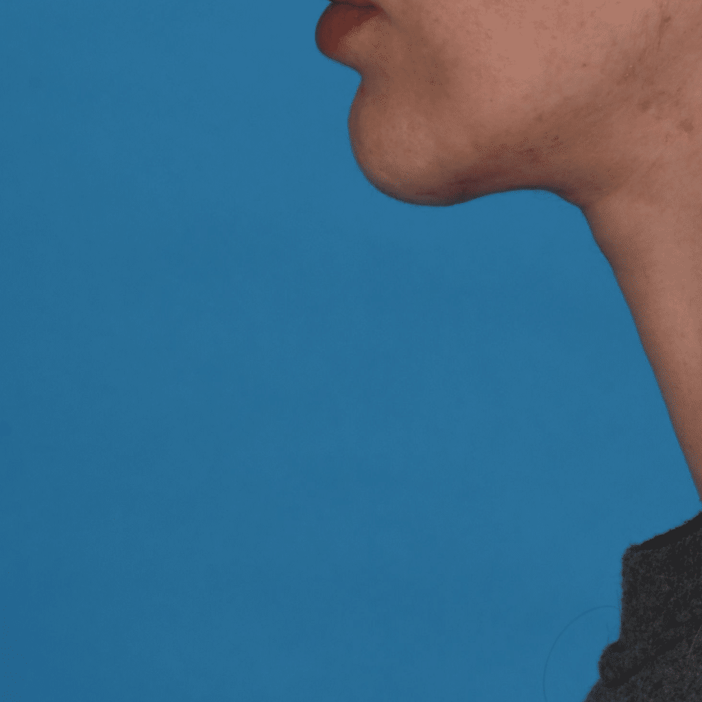 After Image: Facelift/necklift - left-side