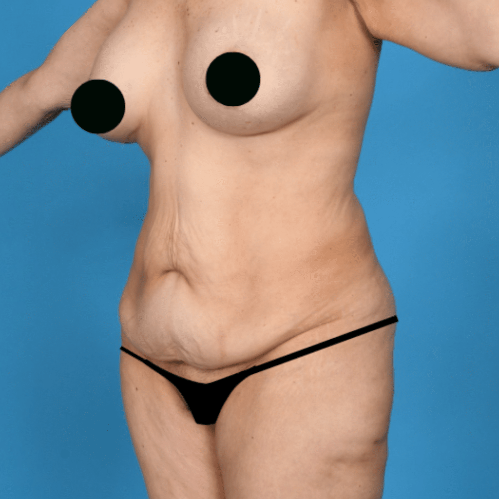 Before Image: Extended abdominoplasty, Liposuction 360 - left-front-oblique