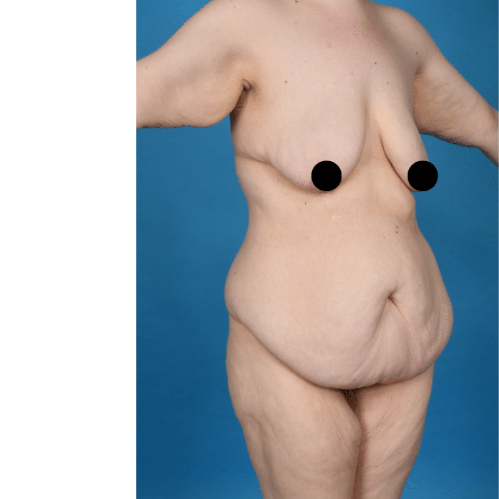 Before Image: Extended abdominoplasty, breast lift (mastopexy) - right-front-oblique