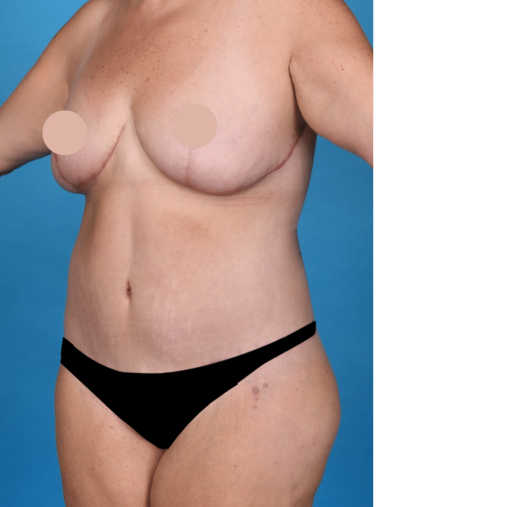 After Image: Circumferential abdominoplasty, bilateral breast reduction, liposuction 360 - back