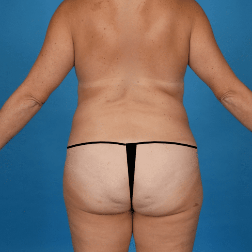 Before Image: Extended abdominoplasty, liposuction 360 - back