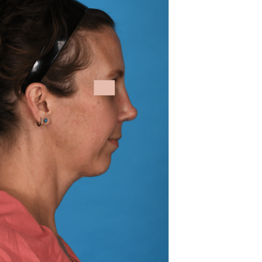 After Image: Revision Rhinoplasty - right-side