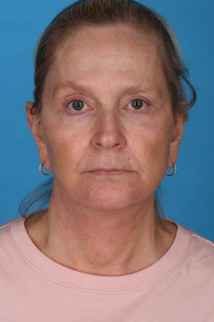 After Image: Facelift, necklift - front