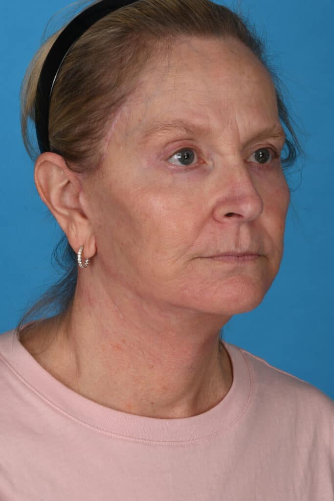 After Image: Facelift, necklift - right-front-oblique