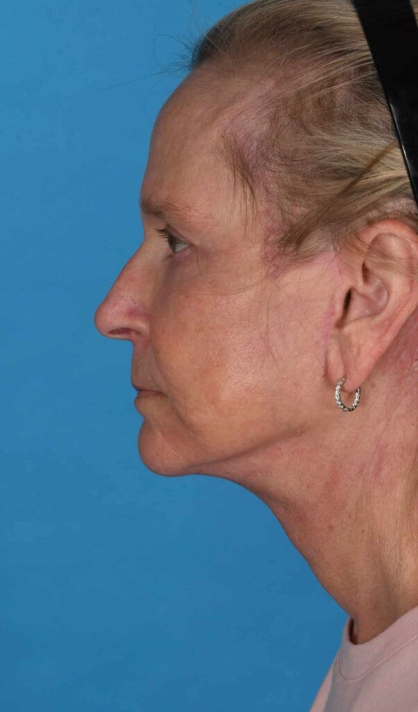 After Image: Facelift, necklift - left-side