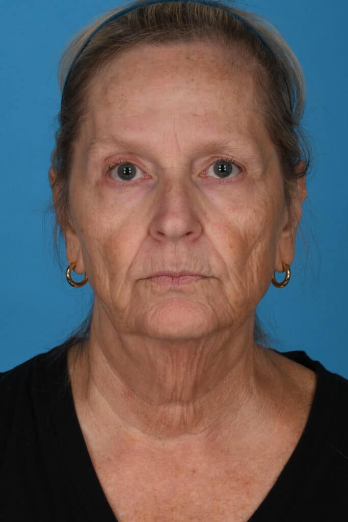 Before Image: Facelift, necklift - front