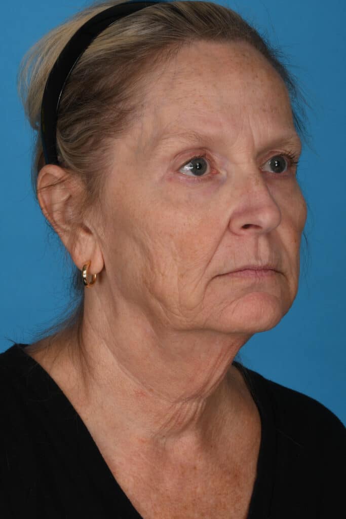 Before Image: Facelift, necklift - right-front-oblique