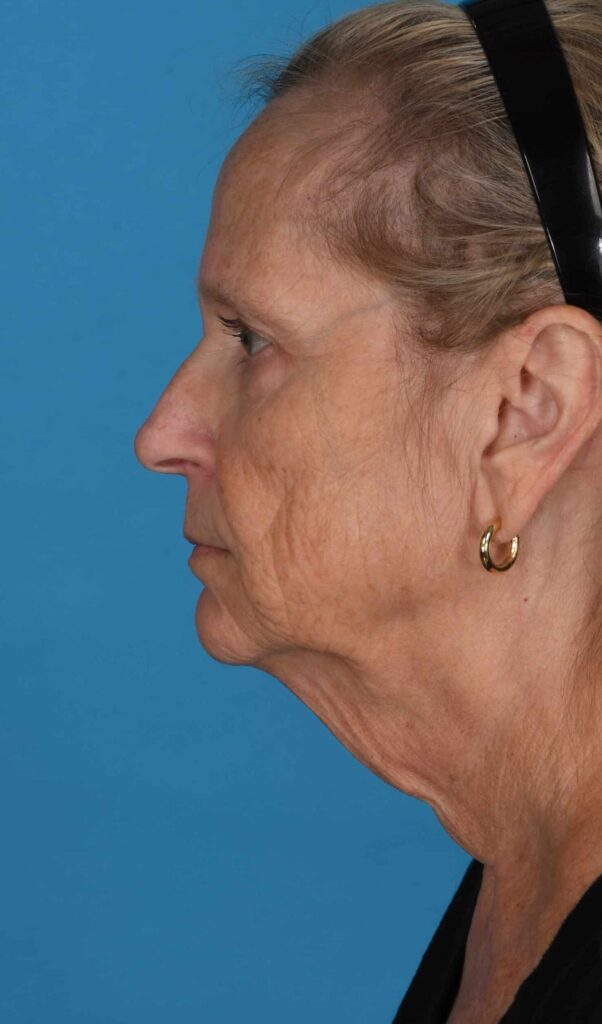 Before Image: Facelift, necklift - left-side
