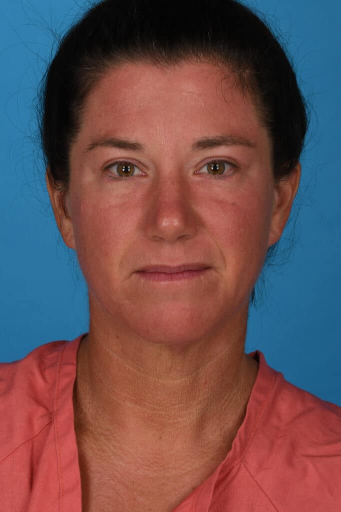 After Image: Lower blepharoplasty - front