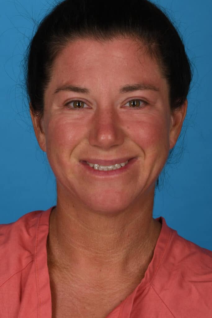 After Image: Lower blepharoplasty - front