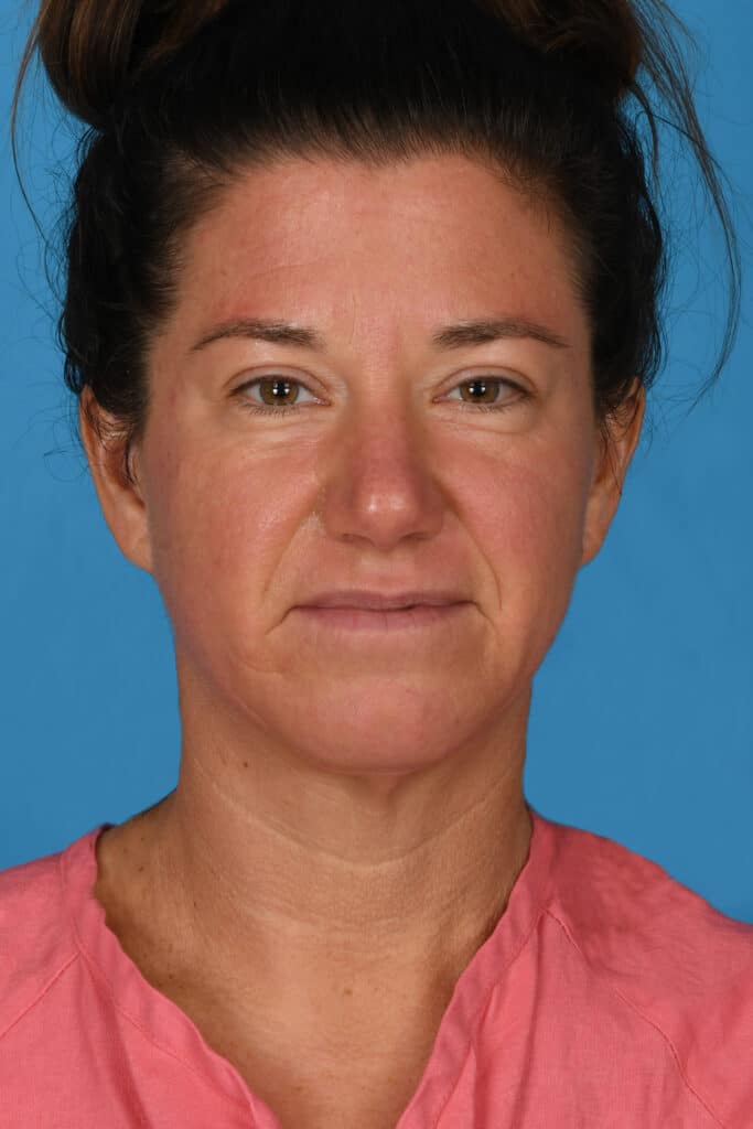 Before Image: Lower blepharoplasty - front