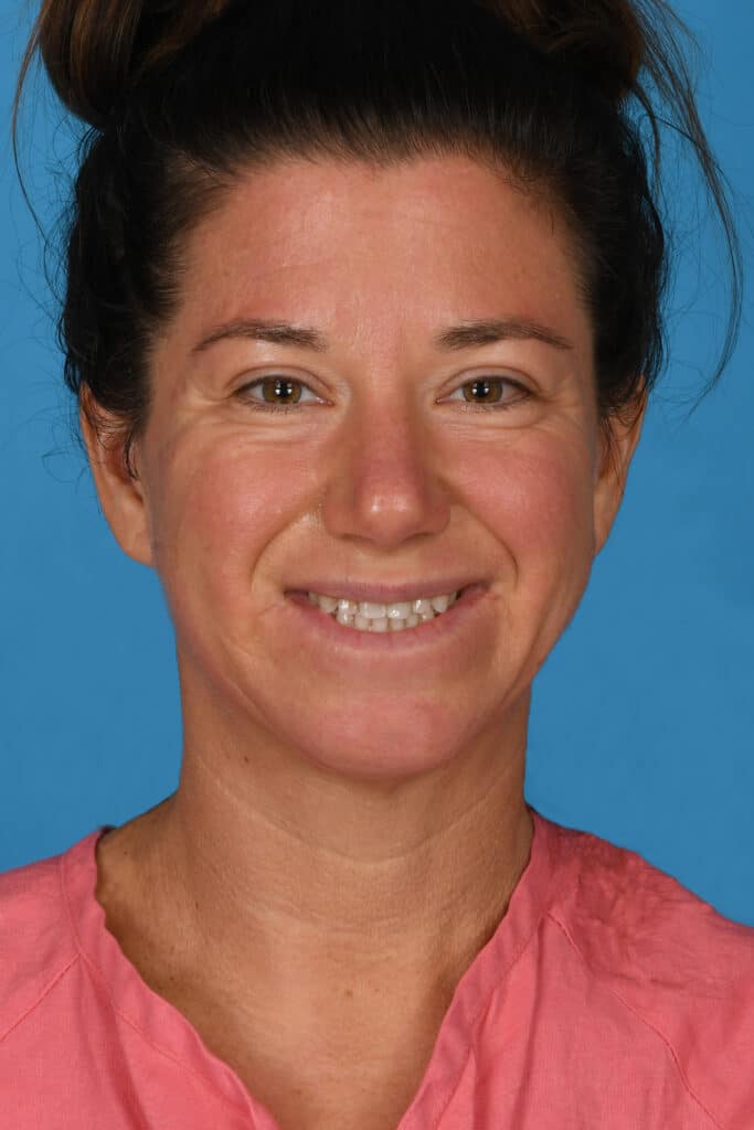 Before Image: Lower blepharoplasty - front