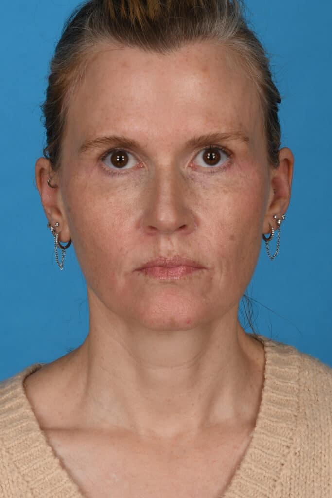 After Image: Blepharoplasty, lateral temporal brow lift, facial fat grafting, laser resurfacing - front