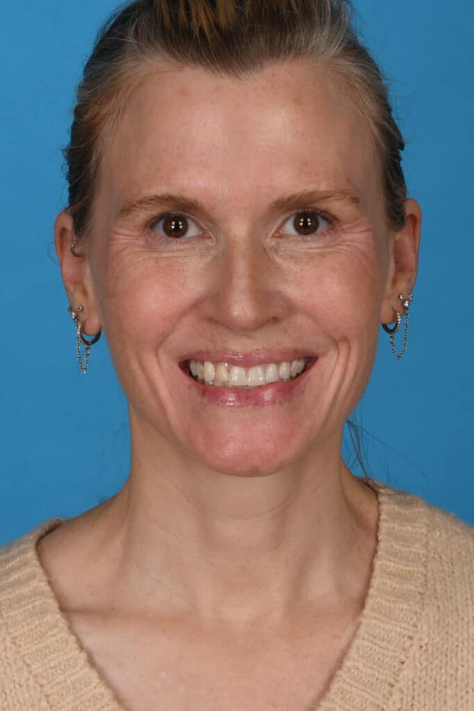 After Image: Blepharoplasty, lateral temporal brow lift, facial fat grafting, laser resurfacing - front