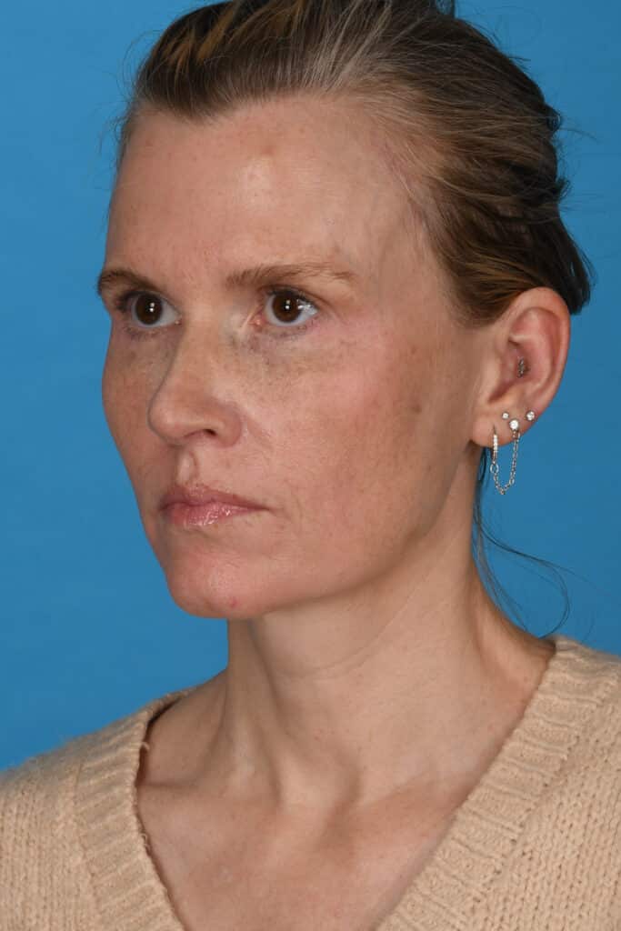 After Image: Blepharoplasty, lateral temporal brow lift, facial fat grafting, laser resurfacing - left-front-oblique