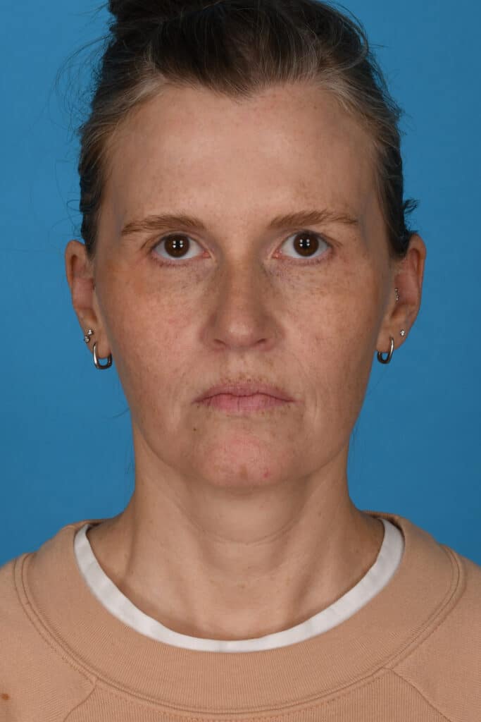 Before Image: Blepharoplasty, lateral temporal brow lift, facial fat grafting, laser resurfacing - front