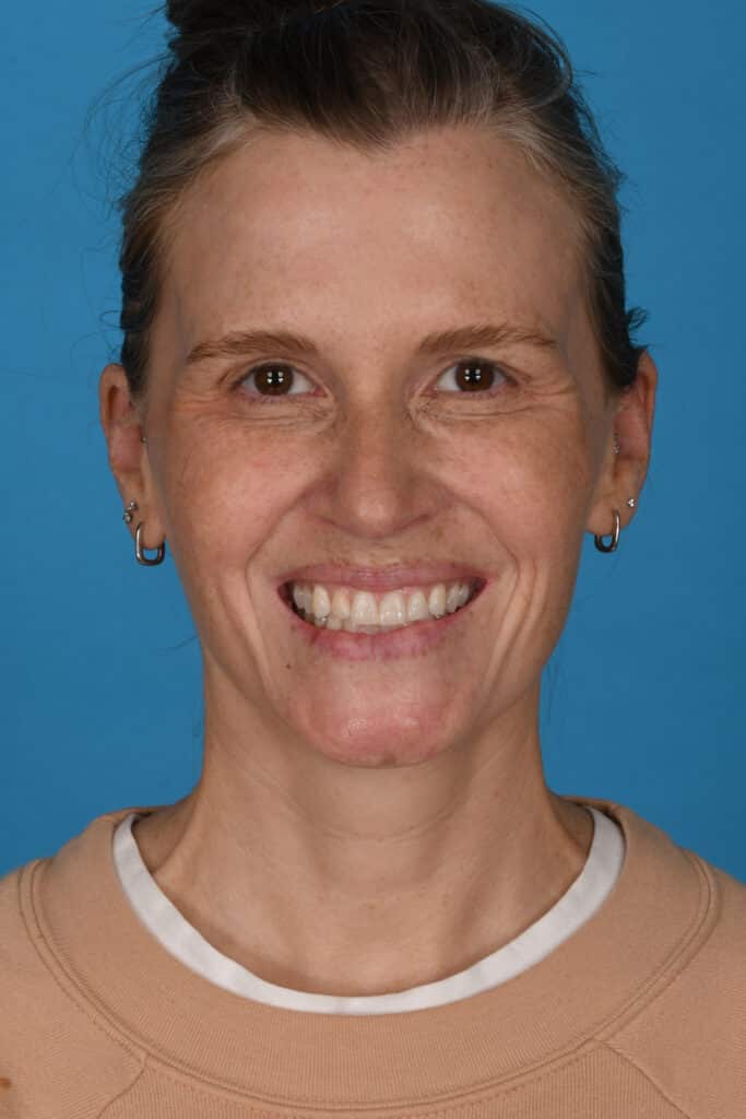 Before Image: Blepharoplasty, lateral temporal brow lift, facial fat grafting, laser resurfacing - front