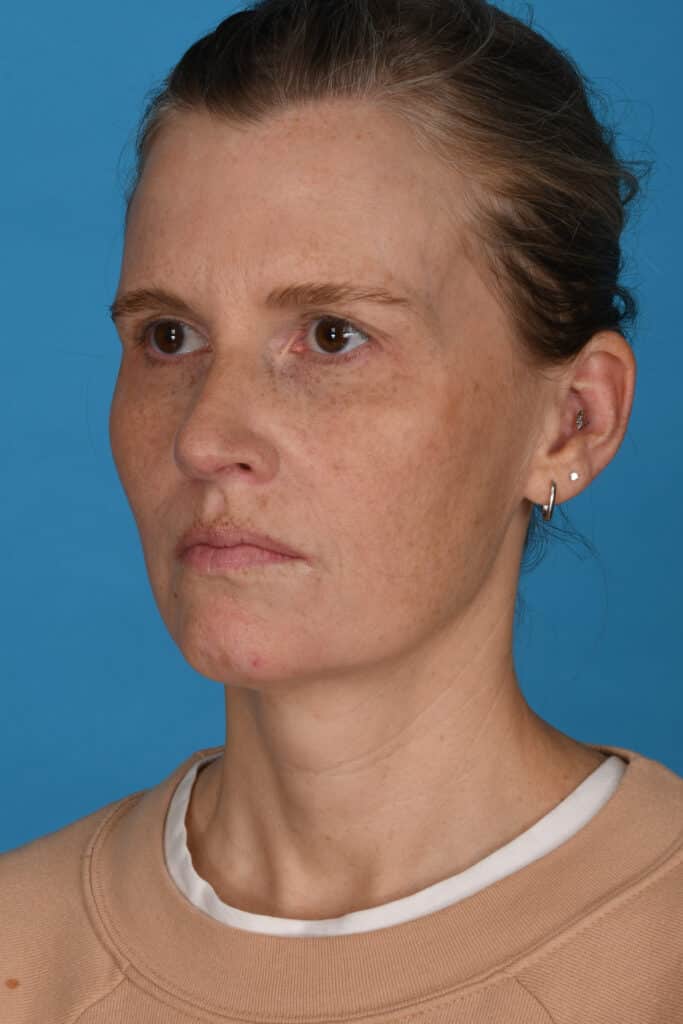 Before Image: Blepharoplasty, lateral temporal brow lift, facial fat grafting, laser resurfacing - left-front-oblique