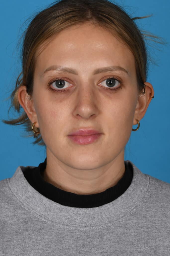 After Image: Rhinoplasty - front