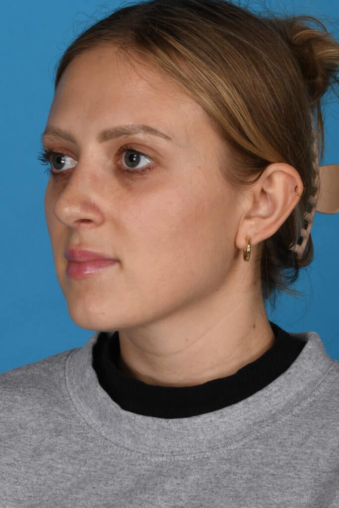 After Image: Rhinoplasty - left-front-oblique