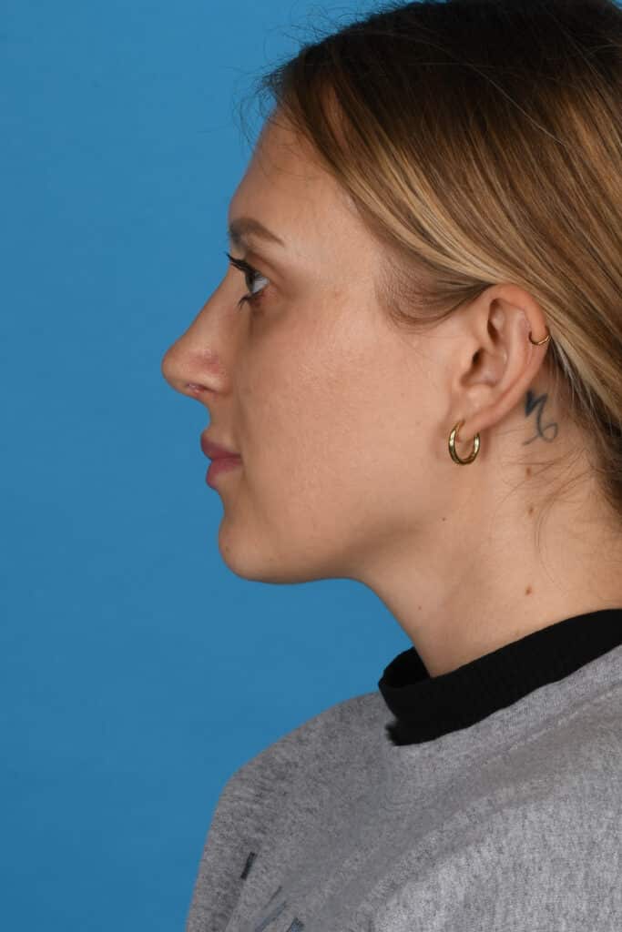 After Image: Rhinoplasty - left-side