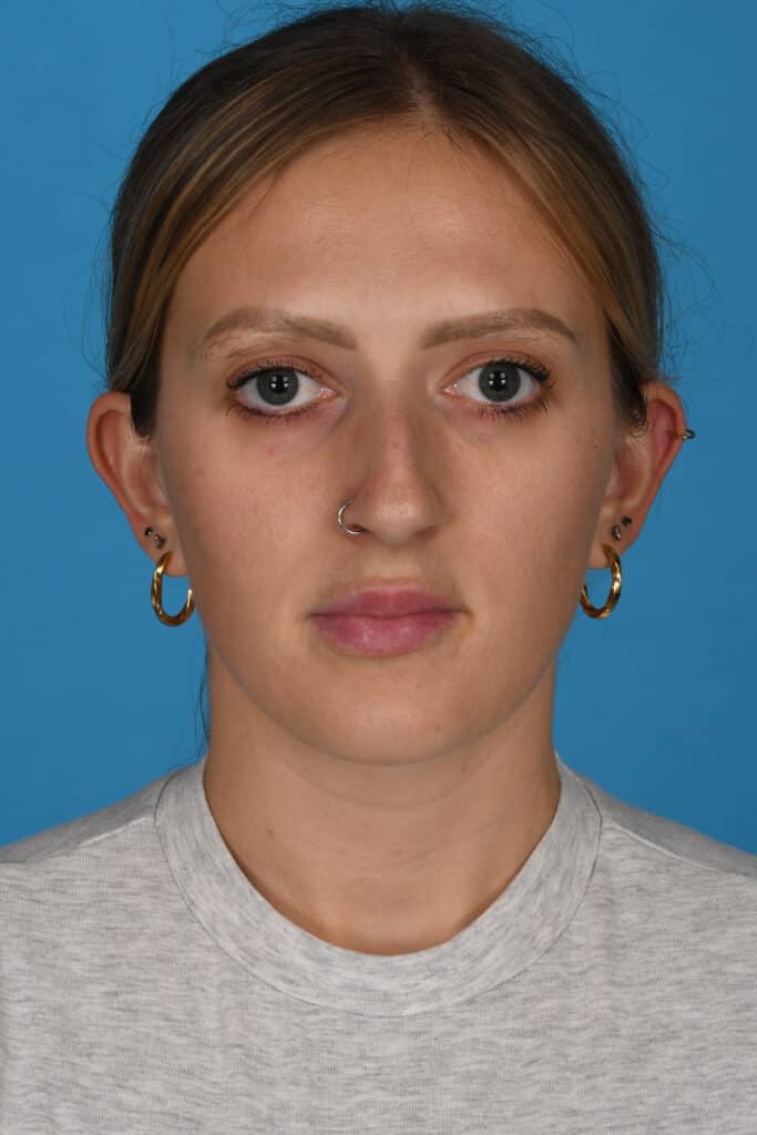 Before Image: Rhinoplasty - front