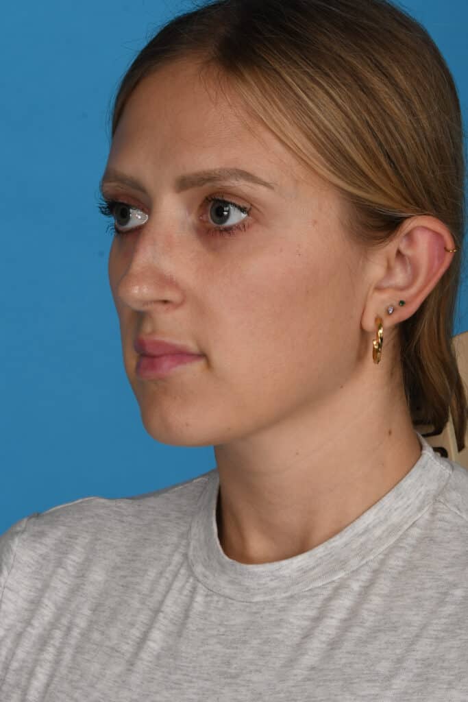 Before Image: Rhinoplasty - left-front-oblique