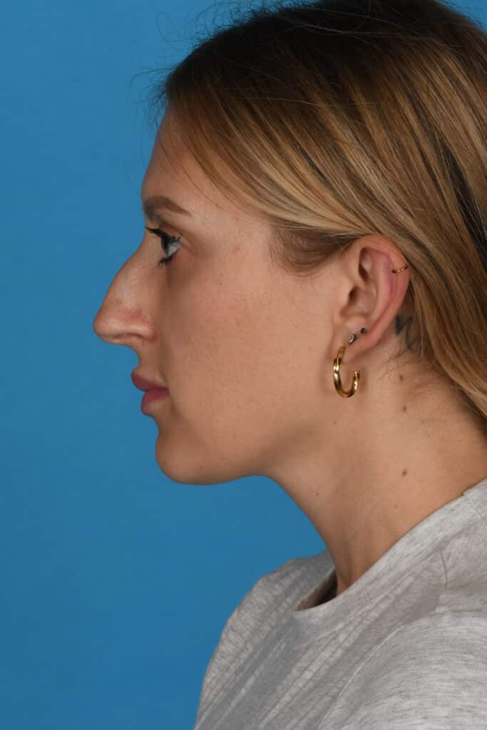 Before Image: Rhinoplasty - left-side