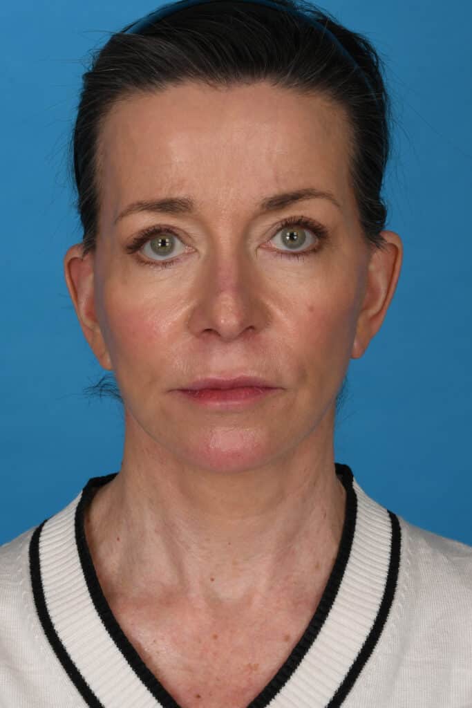 After Image: Facelift, necklift, upper blepharoplasty, laser resurfacing - front
