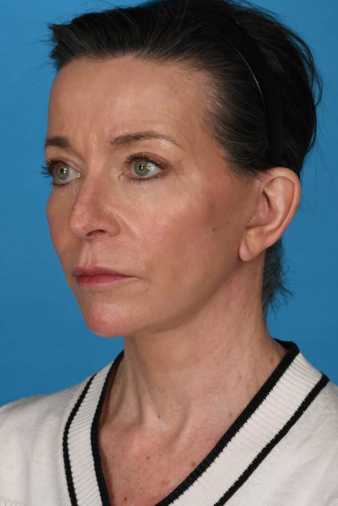 After Image: Facelift, necklift, upper blepharoplasty, laser resurfacing - left-front-oblique