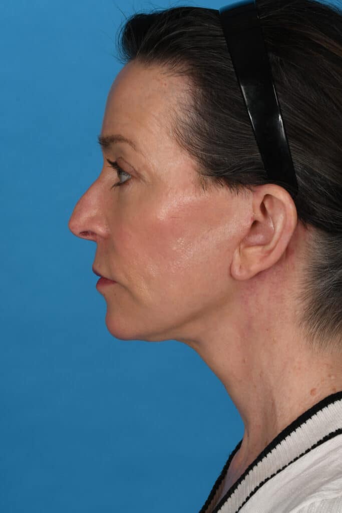 After Image: Facelift, necklift, upper blepharoplasty, laser resurfacing - left-side