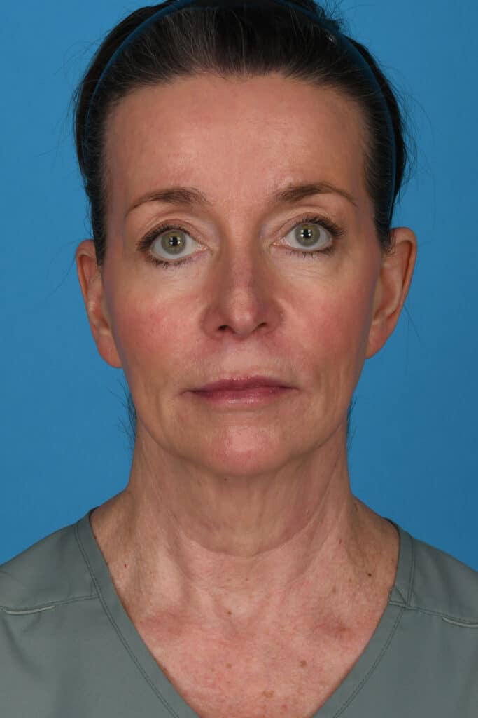 Before Image: Facelift, necklift, upper blepharoplasty, laser resurfacing - front