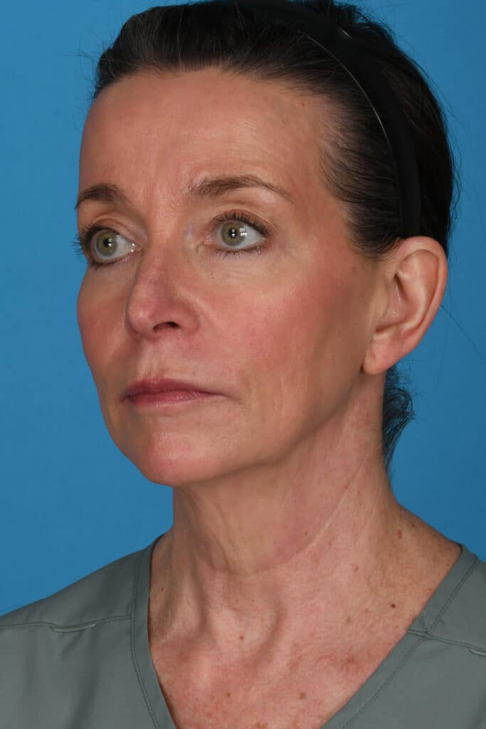 Before Image: Facelift, necklift, upper blepharoplasty, laser resurfacing - left-front-oblique