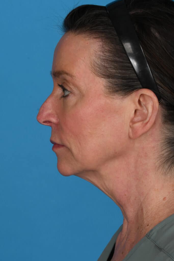 Before Image: Facelift, necklift, upper blepharoplasty, laser resurfacing - left-side