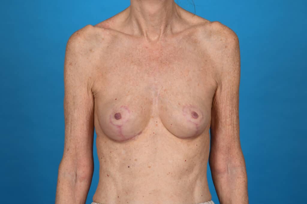 After Image: Breast lift (mastopexy) - front