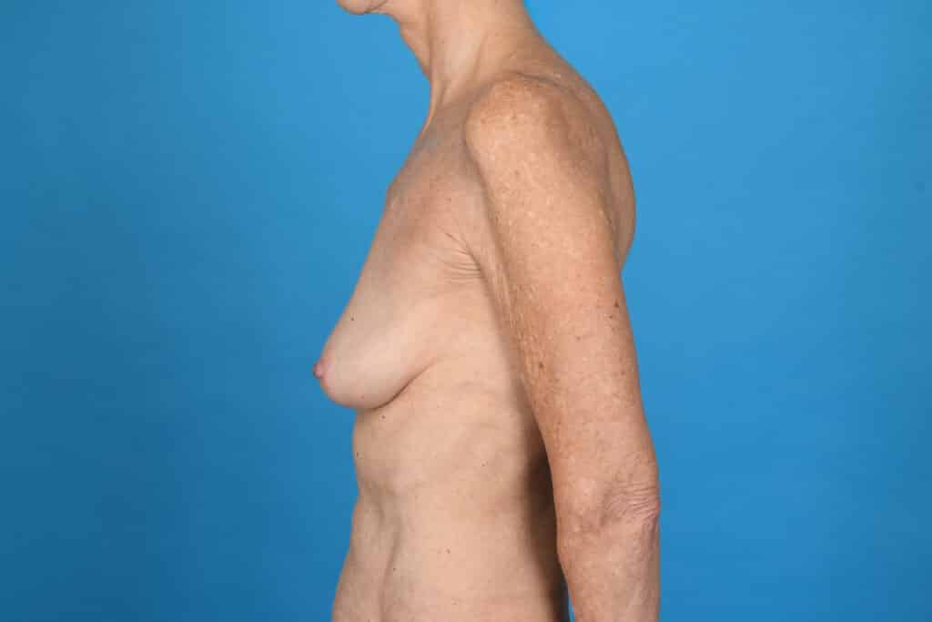 Before Image: Breast lift (mastopexy) - left-side