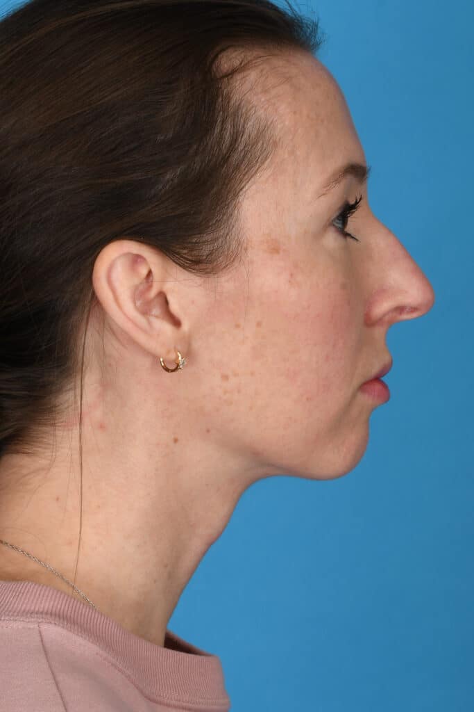 Before Image: Rhinoplasty with chin augmentation - right-side