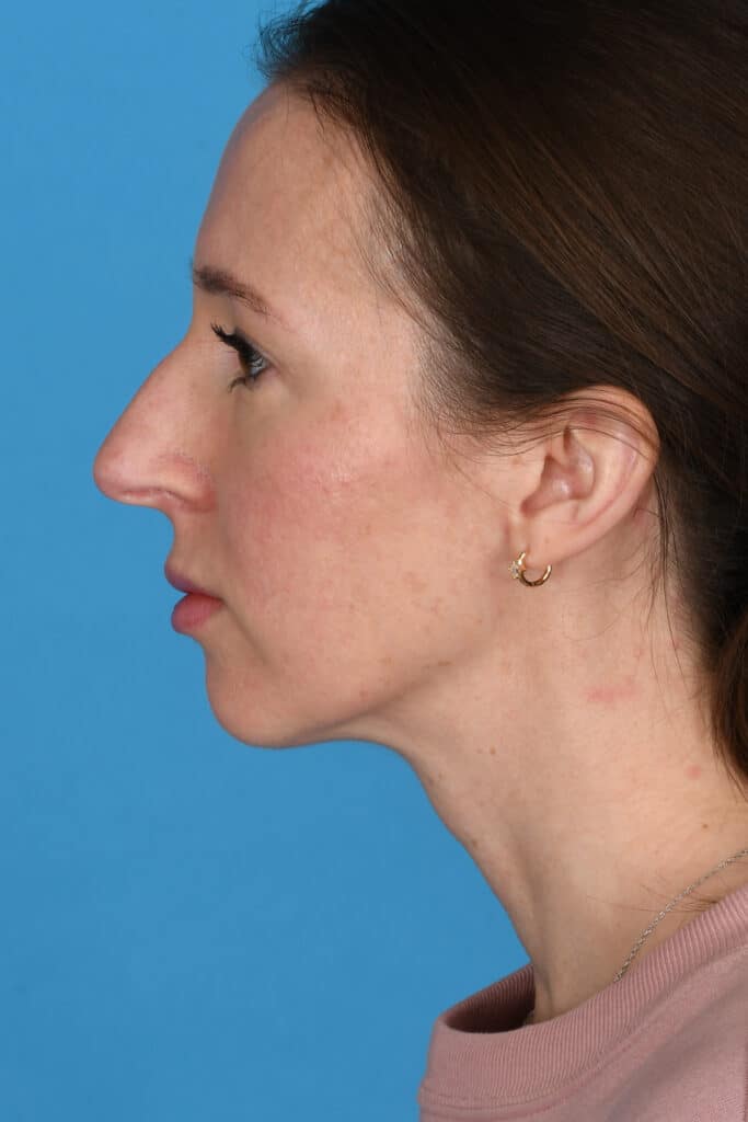 Before Image: Rhinoplasty with chin augmentation - left-side