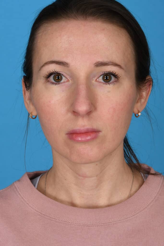 Before Image: Rhinoplasty with chin augmentation - front