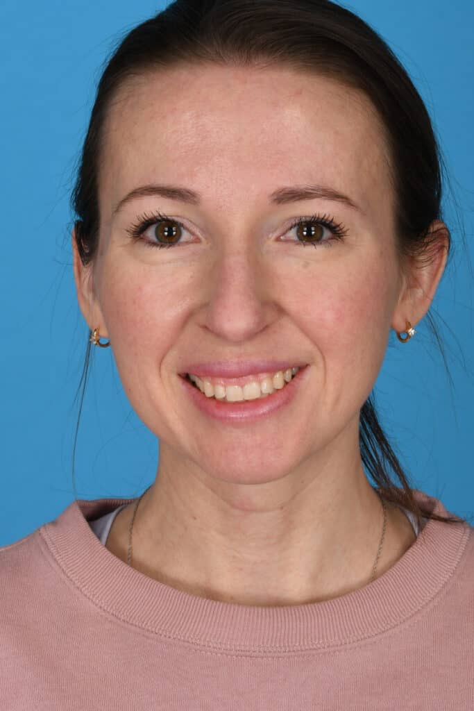Before Image: Rhinoplasty with chin augmentation - front