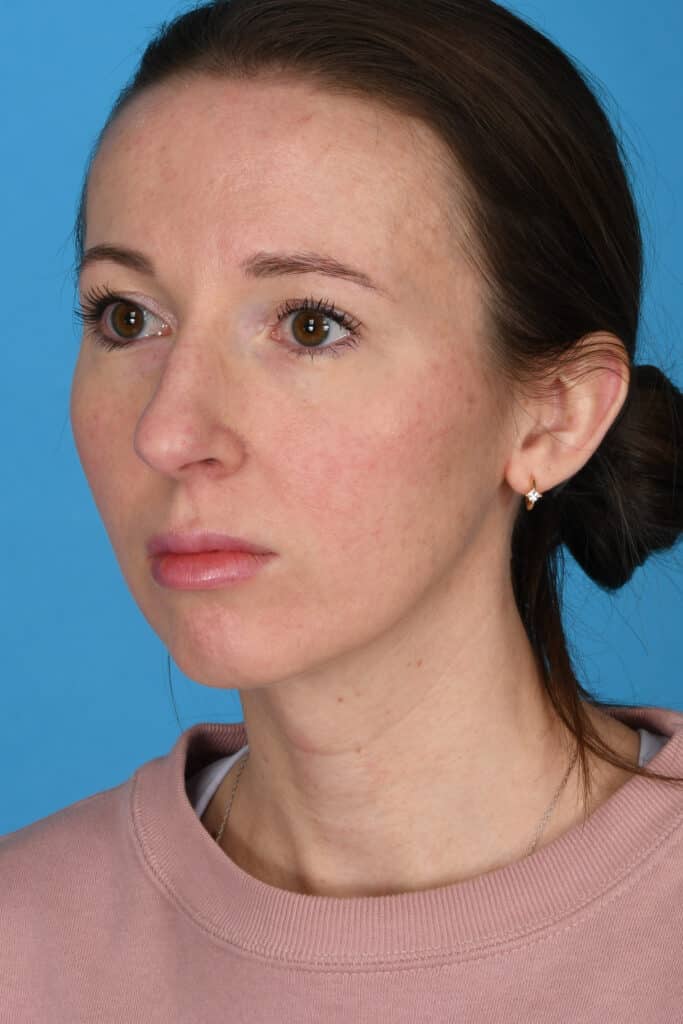 Before Image: Rhinoplasty with chin augmentation - left-front-oblique