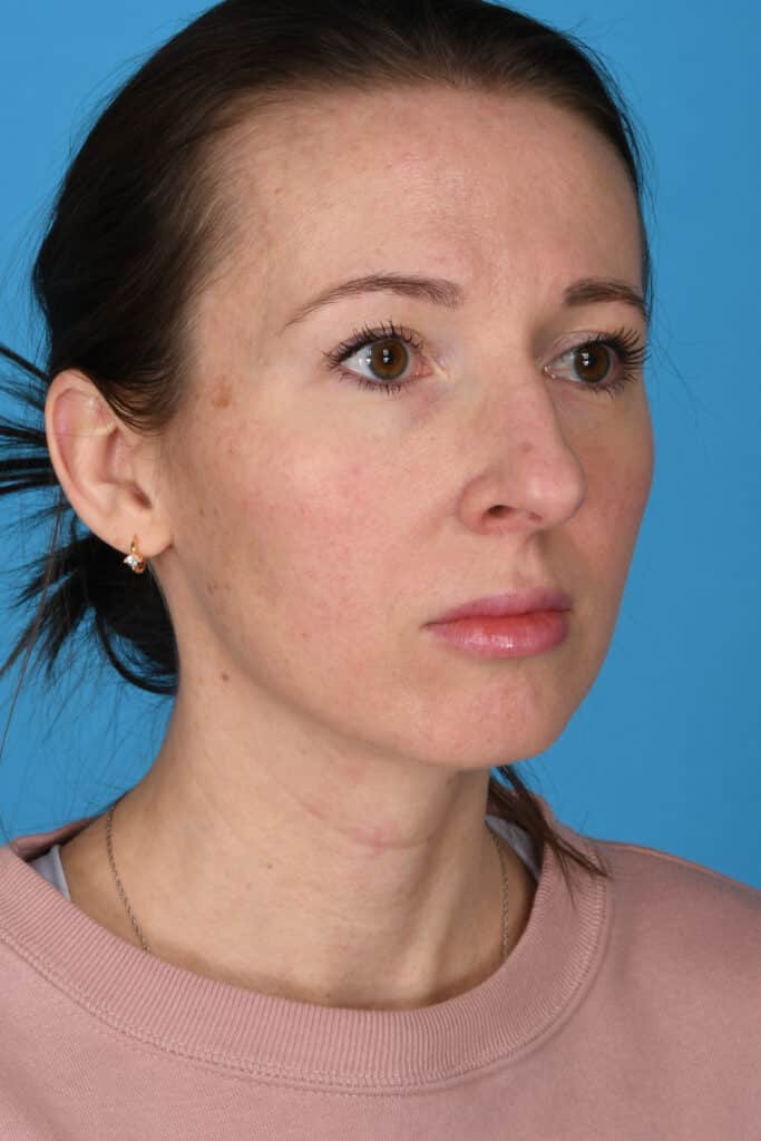 Before Image: Rhinoplasty with chin augmentation - right-front-oblique