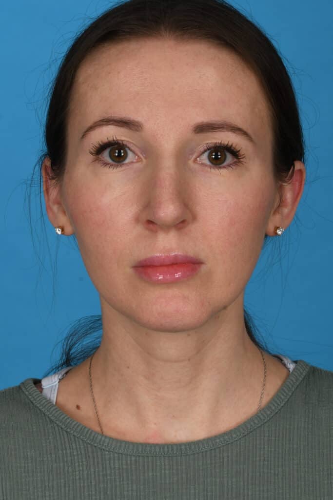 After Image: Rhinoplasty with chin augmentation - front